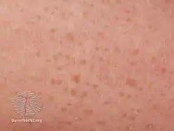 Ichthyosis acquisita