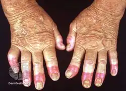 Acrodermatitis continua of Hallopeau