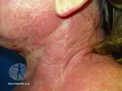 Atopic dermatitis affecting neck