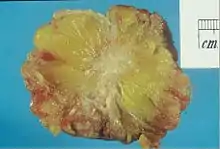 Excised human breast tissue, showing an irregular, dense, white stellate area of cancer 2 cm in diameter, within yellow fatty tissue.