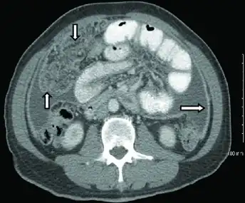 CT scan of peritoneal tuberculosis, a form of extrapulmonary tuberculosis. The omentum and peritoneal surfaces are thickened (arrows).<ref name="AkceBonner2014">Akce M, Bonner S, Liu E, Daniel R (2014). "Peritoneal tuberculosis mimicking peritoneal carcinomatosis". Case Reports in Medicine. 2014: 436568. doi:10.1155/2014/436568. PMC 3970461. PMID 24715911.