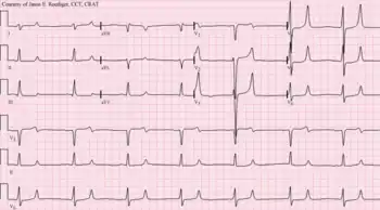 Combined hyperkalemia and hypocalcemia with a potassium of 7.4 mg/dL, showing large T waves and a widened QRS