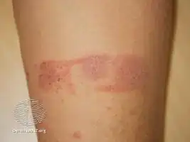 Contact dermatitis to adhesive plaster