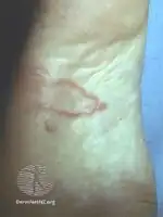 Cutaneous larva migrans