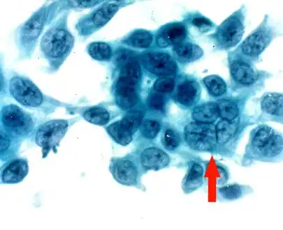 Impression cytology smear stained by Papanicolaou stain shows the presence of a multinucleated giant cell