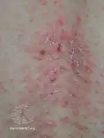 Darier disease on the mid-back