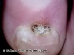 Digital myxoid cyst