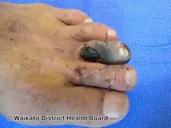 Dry gangrene