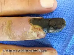 Dry gangrene