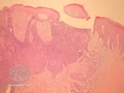 Aggressive digital papillary adenocarcinoma-pathology