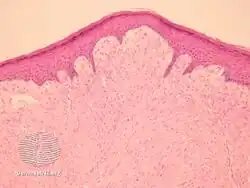Infantile digital fibromatosis/pathology