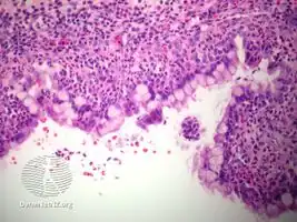pathology-Median raphe cyst