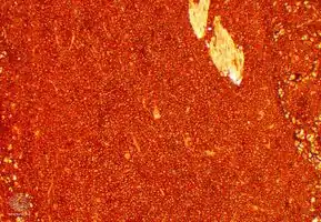 Plasmacytoma/pathology