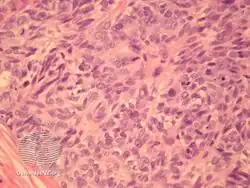 Aggressive digital papillary adenocarcinoma-pathology