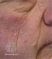 Folliculitis due to vemurafenib