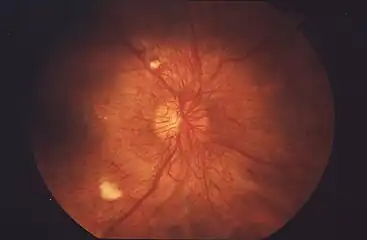 Proleferative diabetic retinopathy