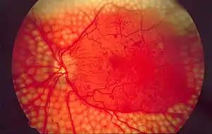 Photograph of retina after scatter laser surgery for diabetic retinopathy.