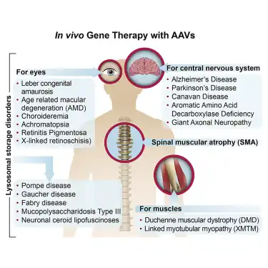 Gene therapy (in vivo ) with AAV