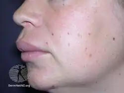 Granulomatous cheilitis