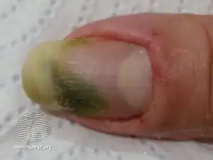 Green nail due to pseudomonas infection