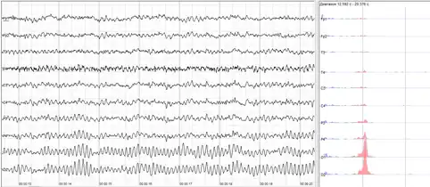 The sample of human EEG with prominent alpha-rhythm in occipital sites