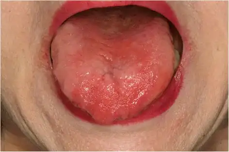 Possible sign of B12 deficiency: redness and depapillation of the tongue.