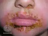 Impetigo with crusts