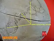 Lambdoid suture with Wormian bones, seen from behind.