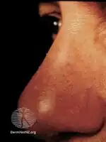 Lupus pernio (cutaneous sarcoidosis)