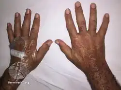 Multicentric reticulohistiocytosis