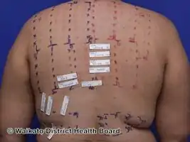Multiple positive reactions to acrylates