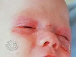 Neonatal lupus