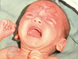 Neonatal lupus