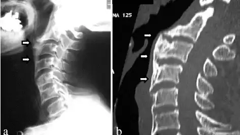 a) Recurrent ossification of  anterior longitudinal ligament with anterior osteophytes arrows was present from C2 to C6 b) computed tomographic images of the cervical spine