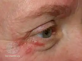 Periorbital dermatitis