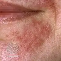 Perioral dermatitis