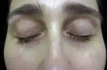 Periorbital hyperpigmentation