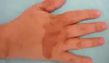 Phytophotodermatoses