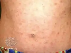 Pityriasis lichenoides chronica