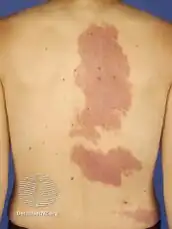 Port-wine stain