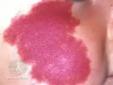 Port-wine stain