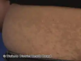 Postinflammatory hypopigmentation after recovery from dengue-like rash in a patient with suspected COVID19