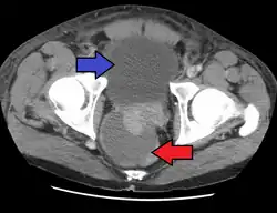 Abscess of the prostate (red arrow) resulting in urinary retention (blue arrow)