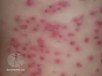 Pseudomonas folliculitis
