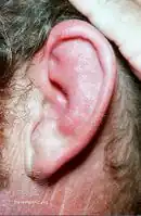 Relapsing polychondritis