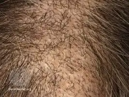 Trichotillomania