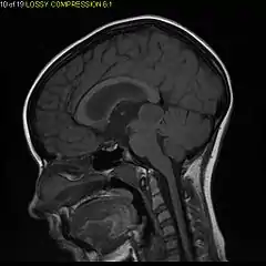 Sagittal T1-weighted MRI showing a well-circumscribed hypointense mass in the tectum (presumably a tectal plate glioma).  These lesions are a distinct subset of pilocytic astrocytoma which present with hydrocephalus typically in 6 to 10 year-olds and are rarely progressive lesions. When imaging is characteristic, a biopsy is usually not performed because of the risks to adjacent structures, often shunting to relieve intracranial pressure is the only treatment required.