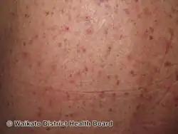 Transient acantholytic dermatosis