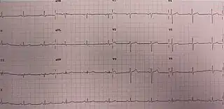 ECG in someone with Wellens' syndrome when having chest pain
