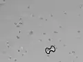 Urine microscopy showing a calcium oxalate monohydrate crystal (dumbbell shaped) and a calcium oxalate dihydrate crystal (envelope shaped) along with several erythrocytes.